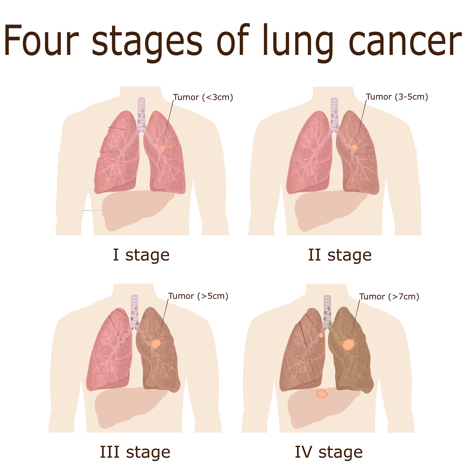 LUNG CANCER