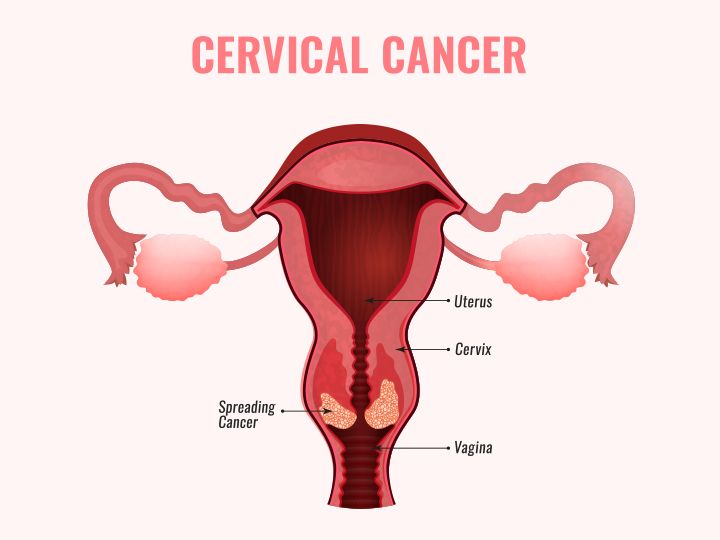 CERVICAL CANCER