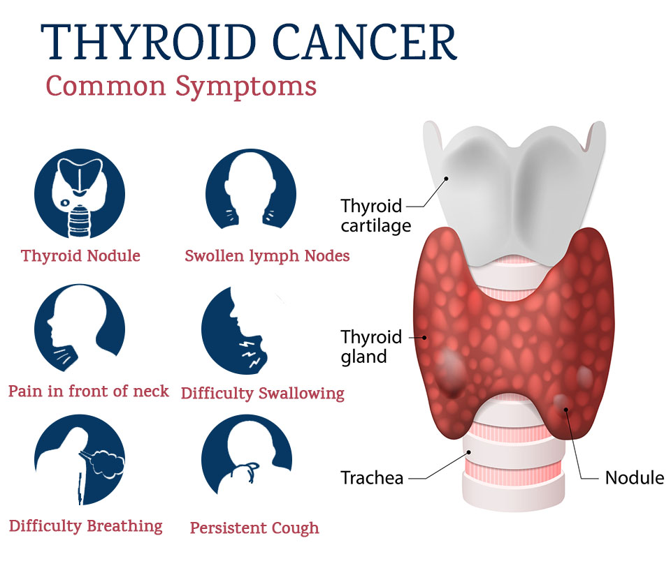 THYROID CANCER