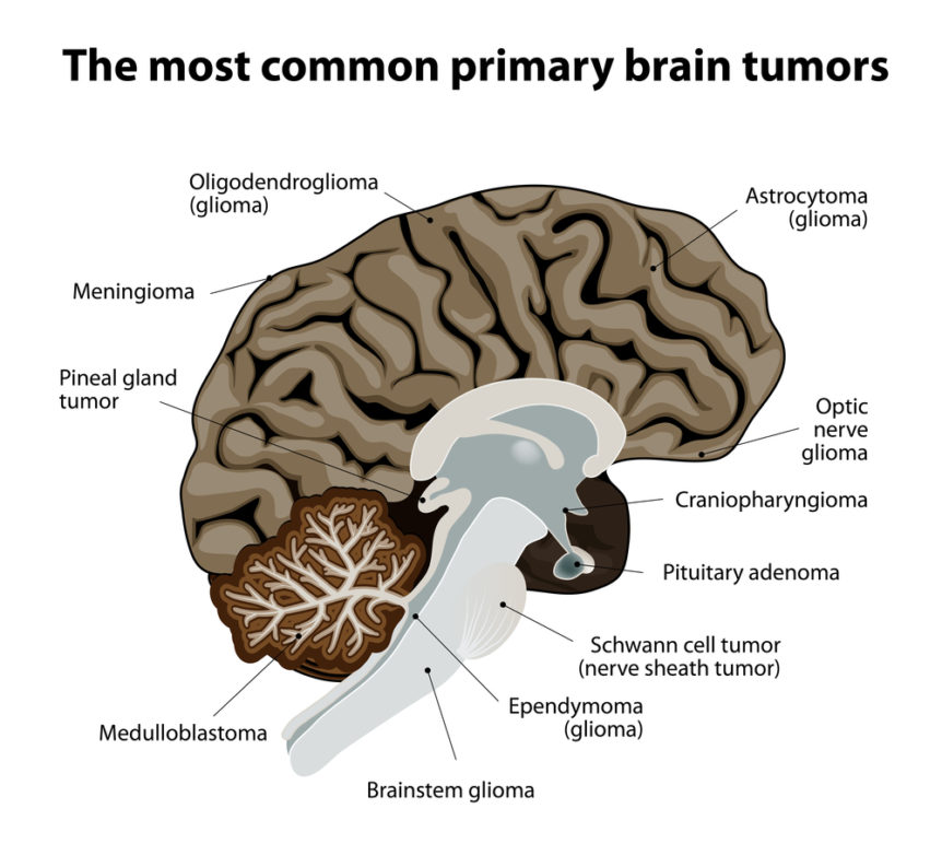 BRAIN CANCER