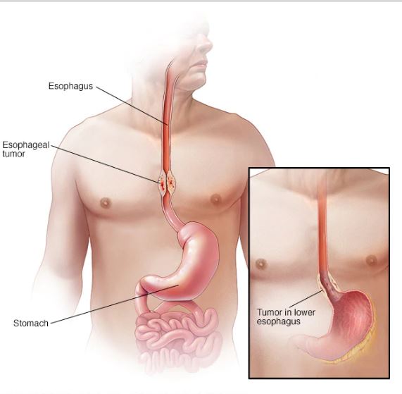 OESOPHAGAL CANCER