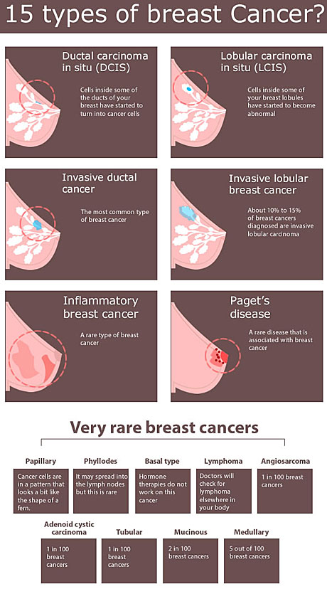 BREAST CANCER