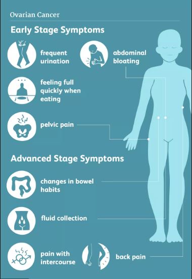 OVARIAN CANCER