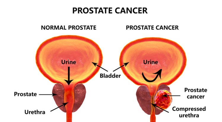 PROSTATE CANCER