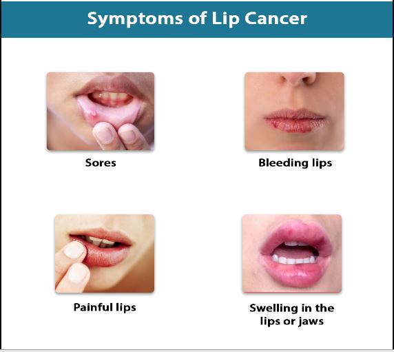 ORAL CANCER