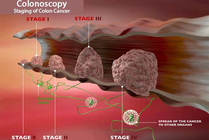 COLON CANCER